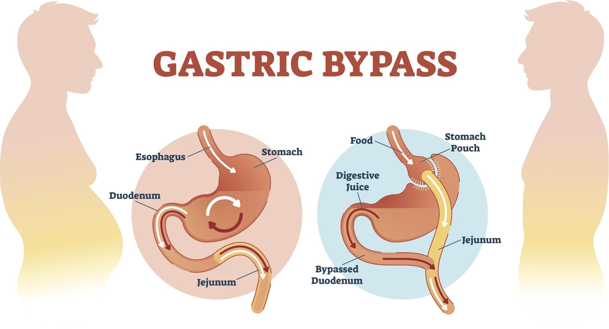 Gastric Bypass nadelen