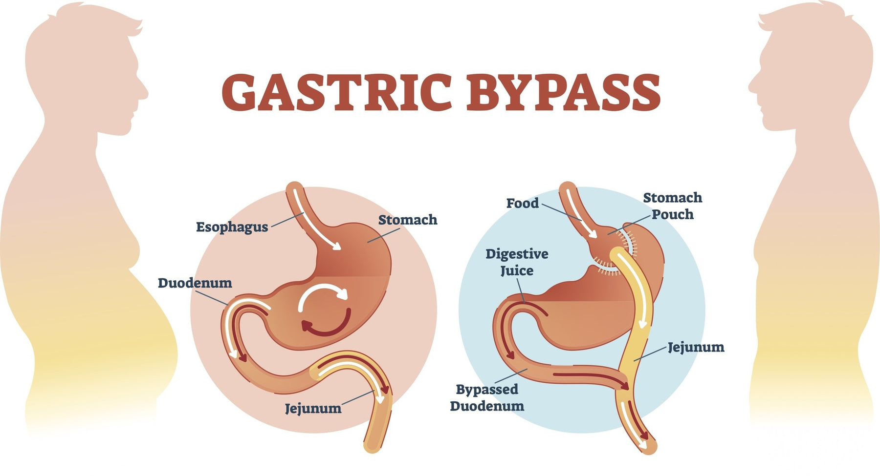 Gastric Bypass nadelen