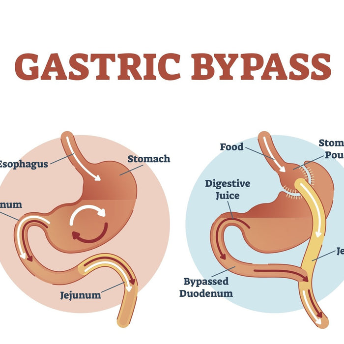 Gastric Bypass nadelen