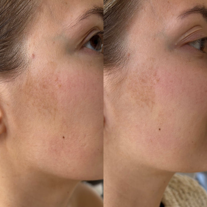 Ray Anti-Pigmentvlekken Serum